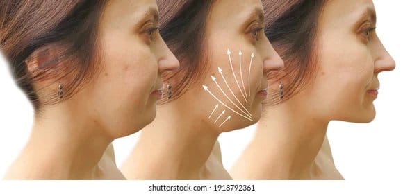 woman double chin before after 260nw 19187923612589642231627960806